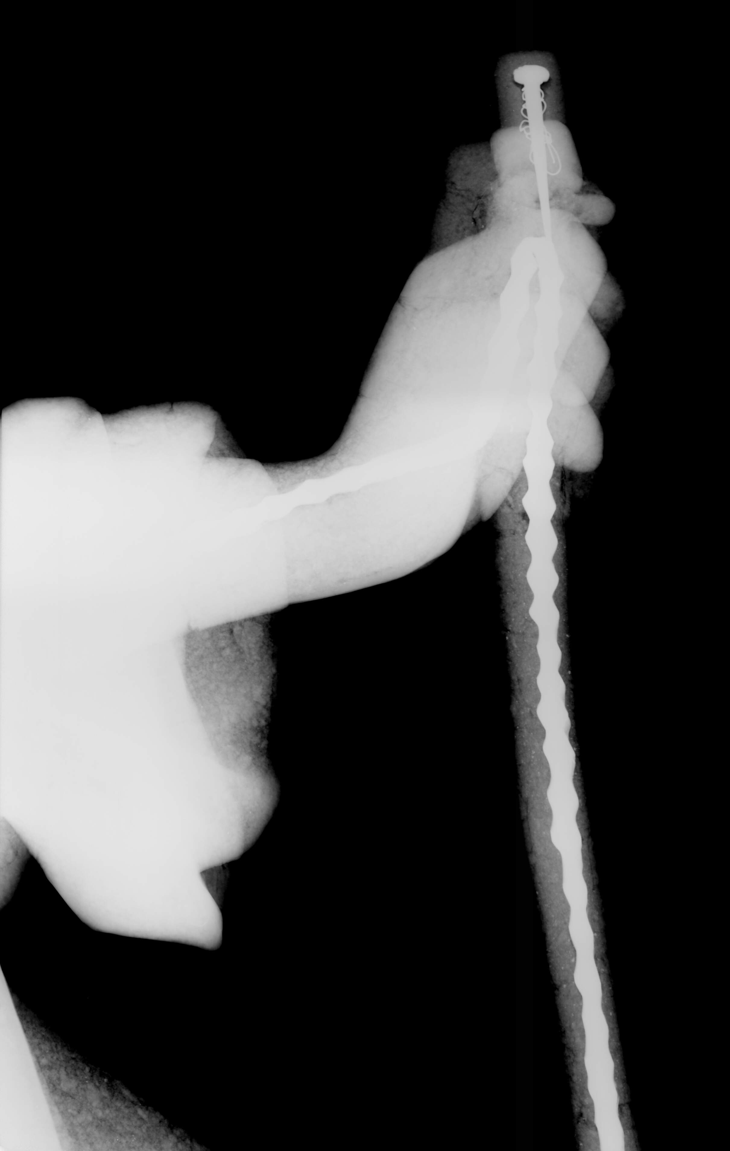 An X-ray image showing the iron bars inside the arm of the statue.